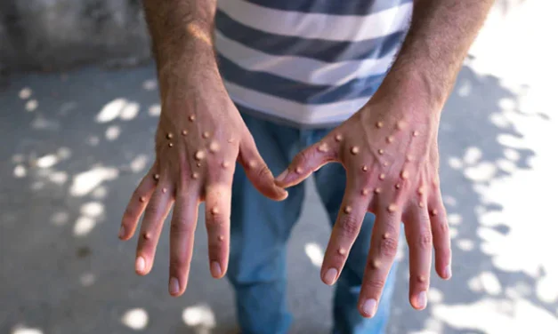 मङ्कीपक्स सङ्क्रमणको मृत्युदर चार प्रतिशत पुग्यो